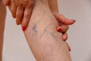 An elderly women with spider veins touching her leg.