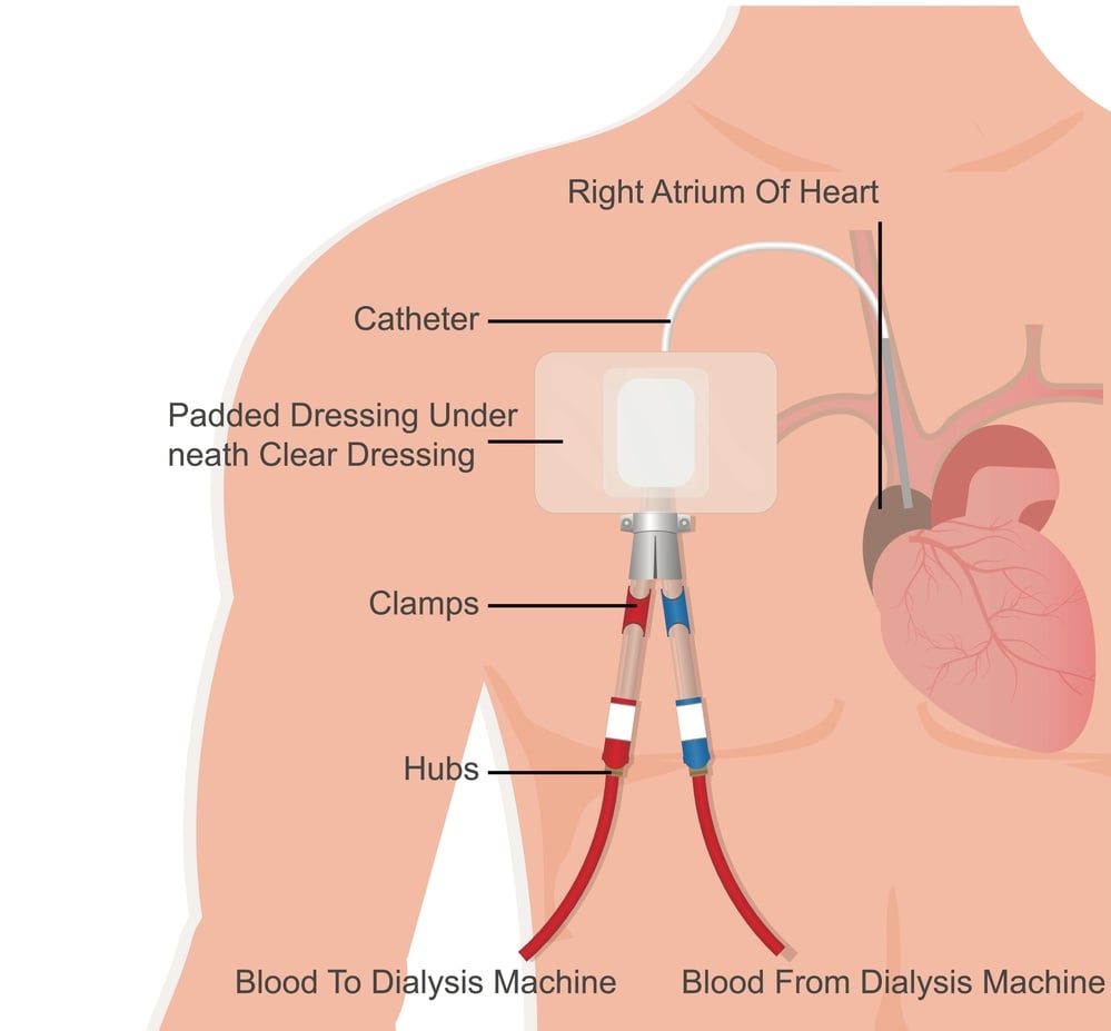 Vascular access for hemodialysis permanent catheter diagram
