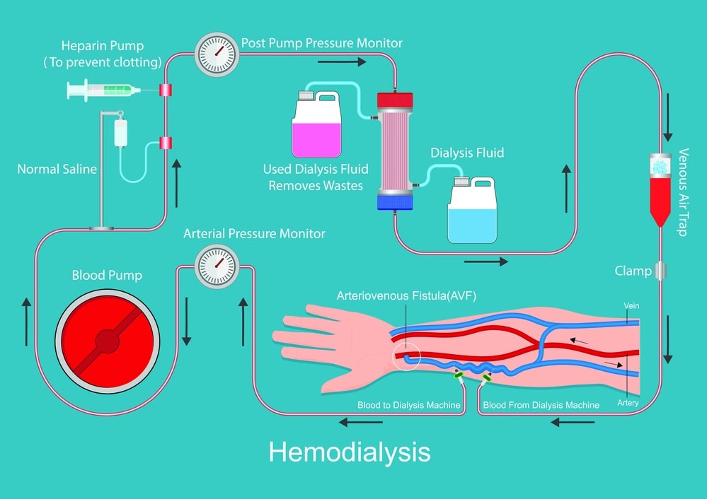 diagram of a fistula for dialysis in a drawing of an arm